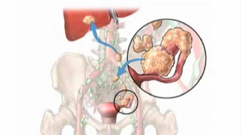 Yumurtalıklardaki kistler: Yırtılması tehlikeli midir? Peki ya hamilelikte?