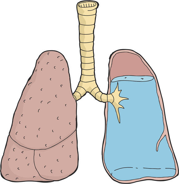 Pulmoner ödem: Pulmoner ödem neden oluşur? Yaygın bir ölüm nedeni midir?