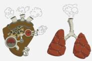 Pulmoner hipertansiyon: nedir ve neden ortaya çıkar? + Belirtiler ve tedavi