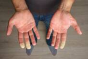 Raynaud sendromu: Parmak uyuşmasının nedeni nedir?